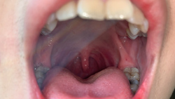 [个人] [*注意]观察公鸡女人嘴巴的内部（喉咙下巴），是龋齿，疾病，巨大的喉咙下巴和杰作！安里