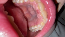 Tooth row with extremely few treatment marks but ugly tooth color Yu KITR00278