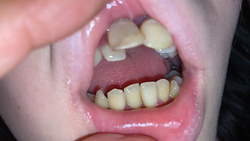 出现口头怪物！充满填充青叶的两阶段前牙和后牙KITR00313
